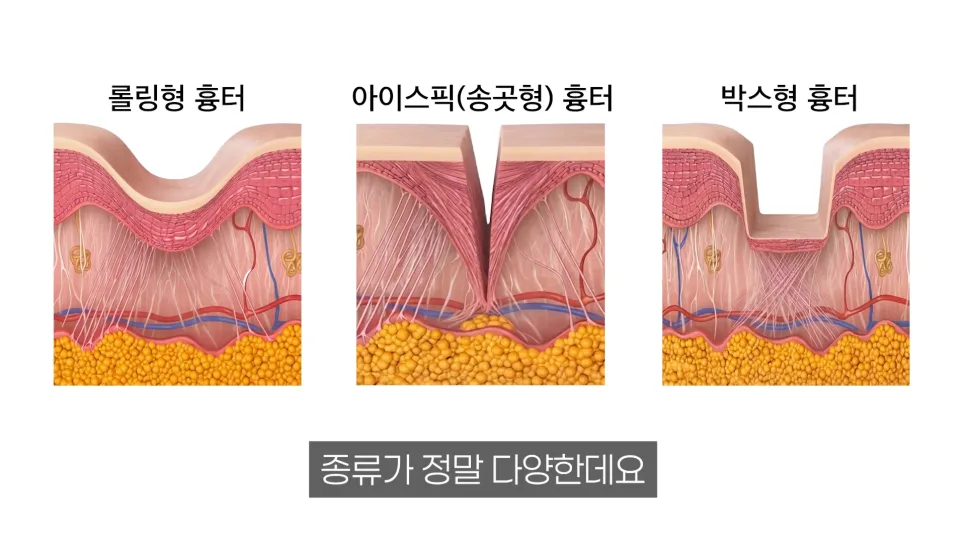 미세바늘 기기 주의